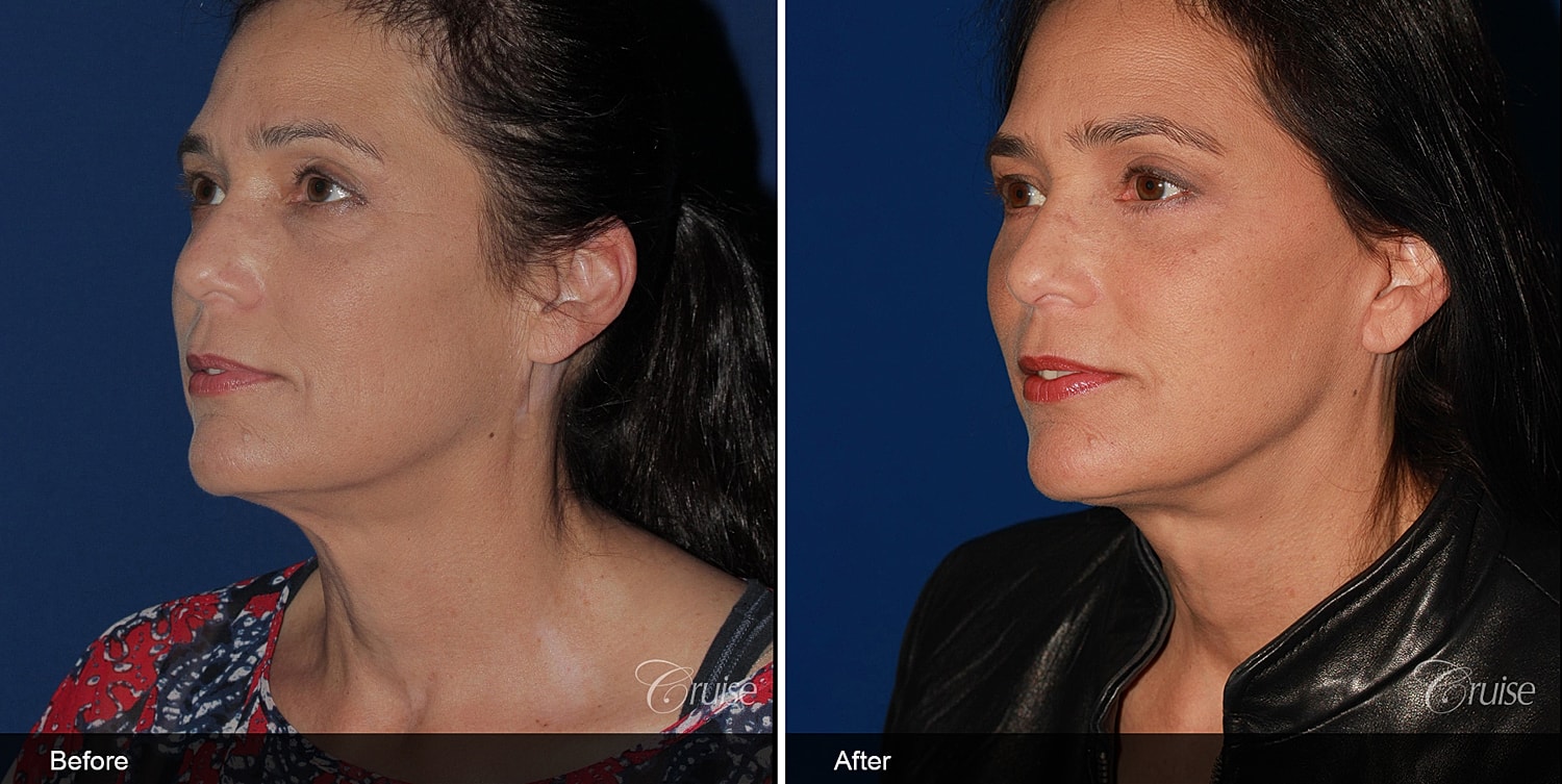 Neck Lift Before & After