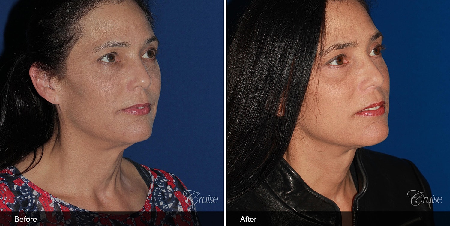 Neck Lift Before & After