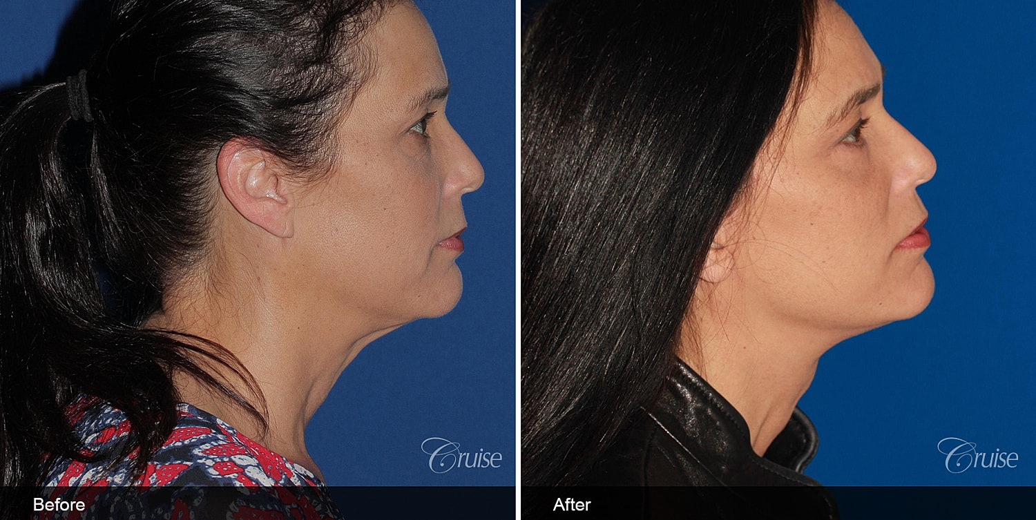 Neck Lift Before & After