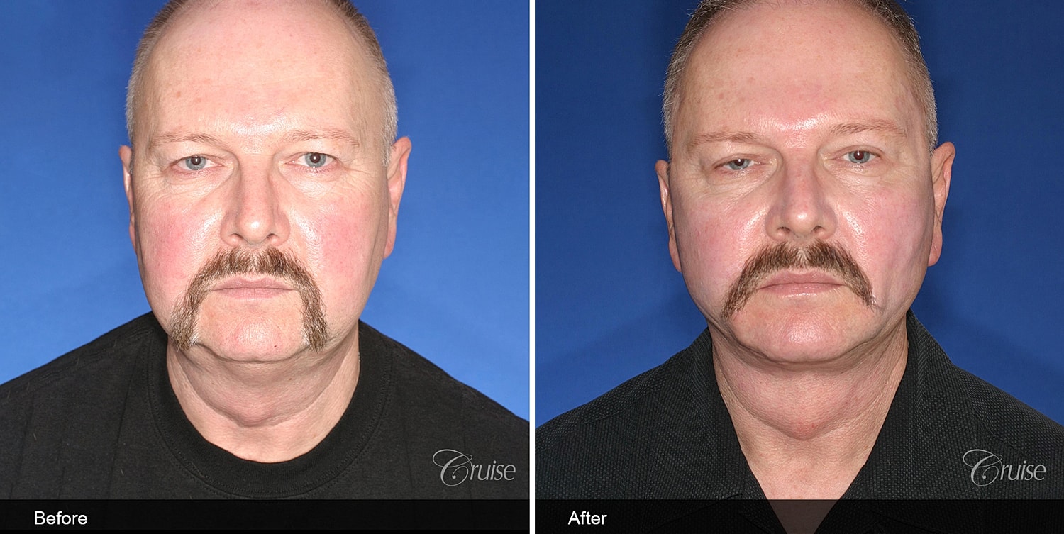Neck Lift Before & After