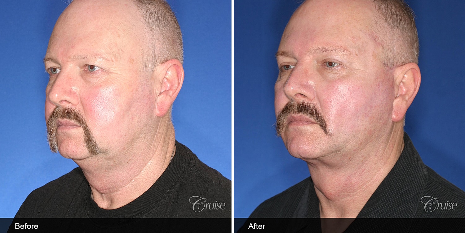 Neck Lift Before & After