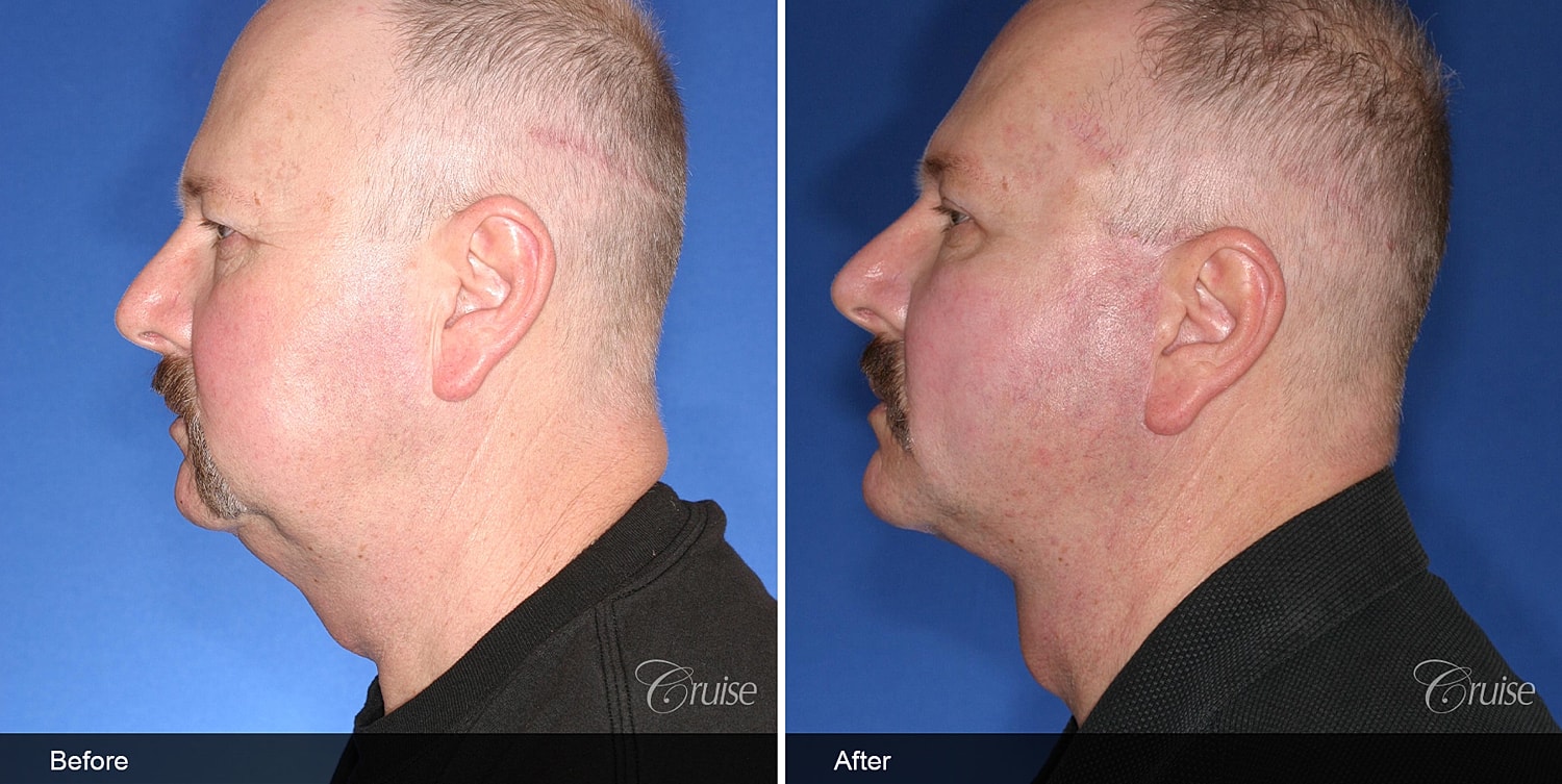 Neck Lift Before & After