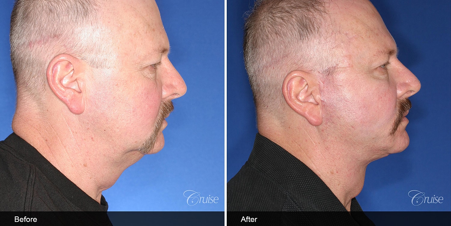 Neck Lift Before & After
