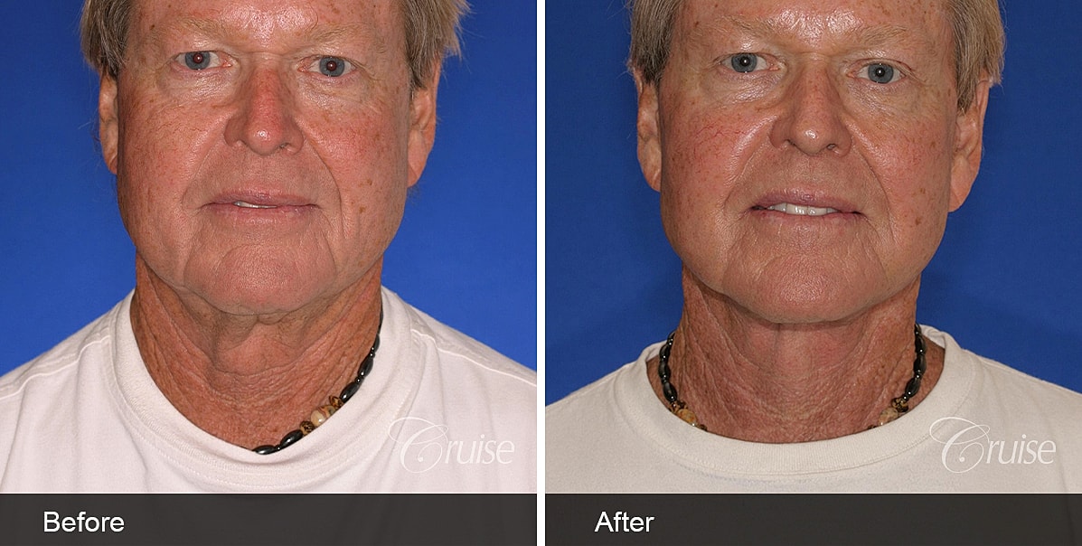 Neck Lift Before & After
