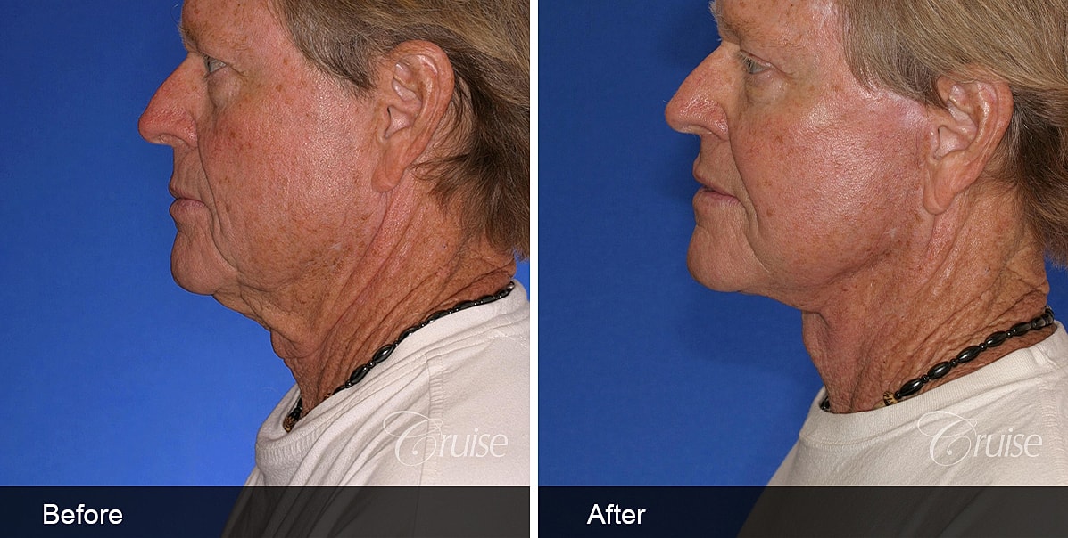 Neck Lift Before & After