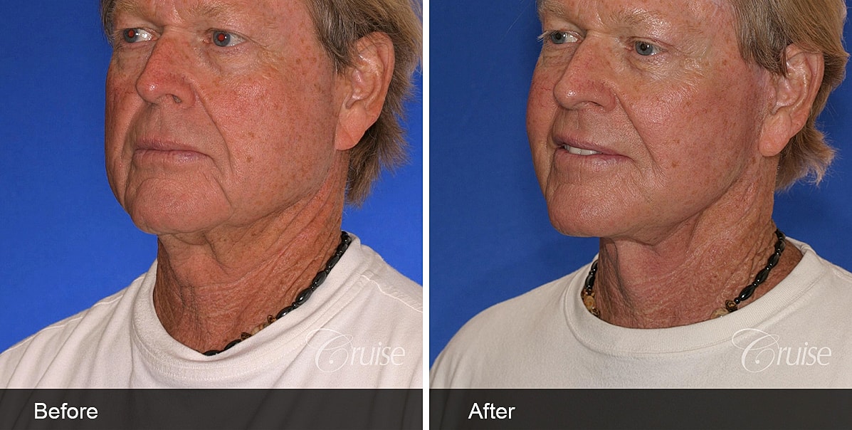 Neck Lift Before & After