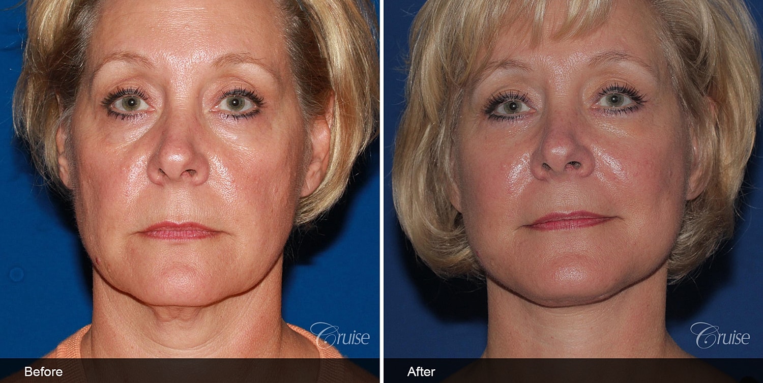 Neck Lift Before & After