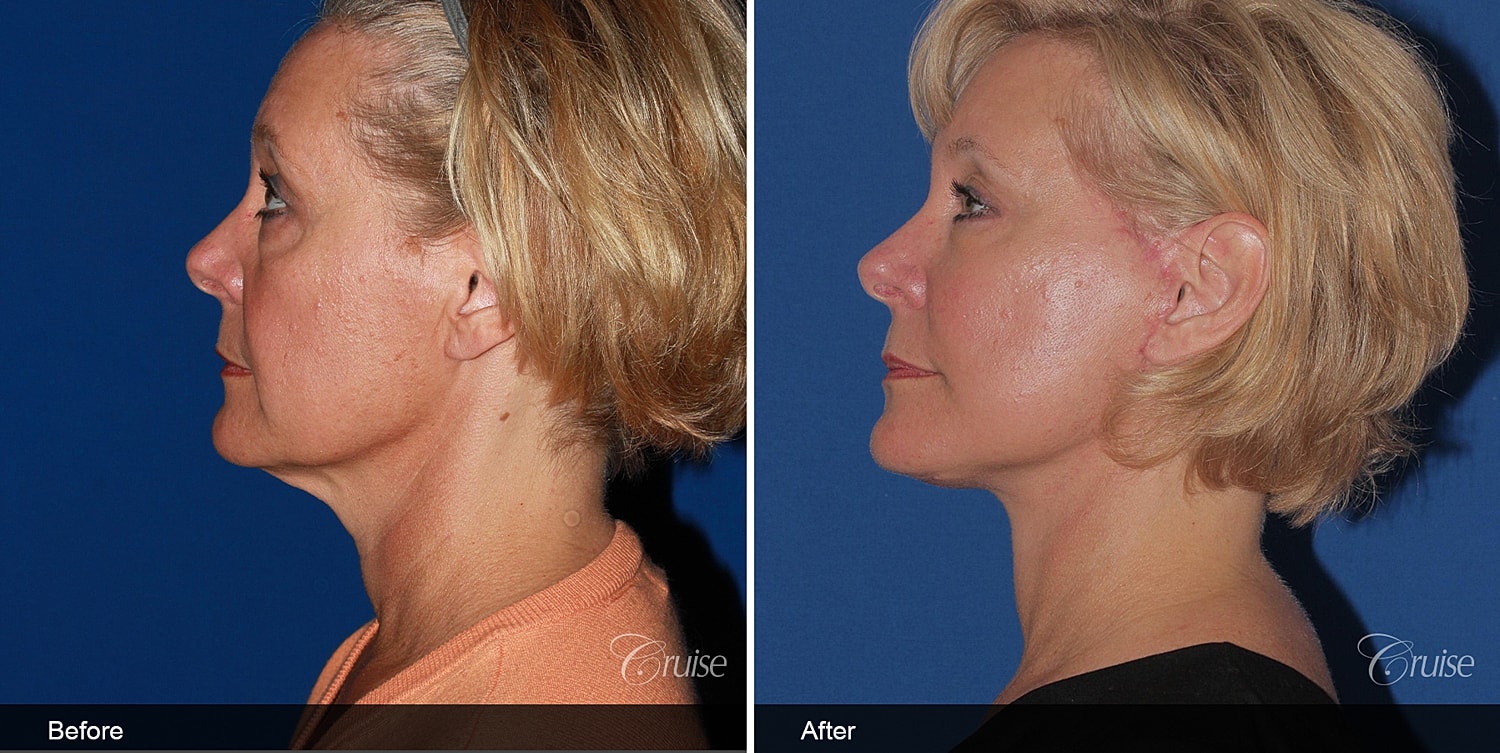 Neck Lift Before & After