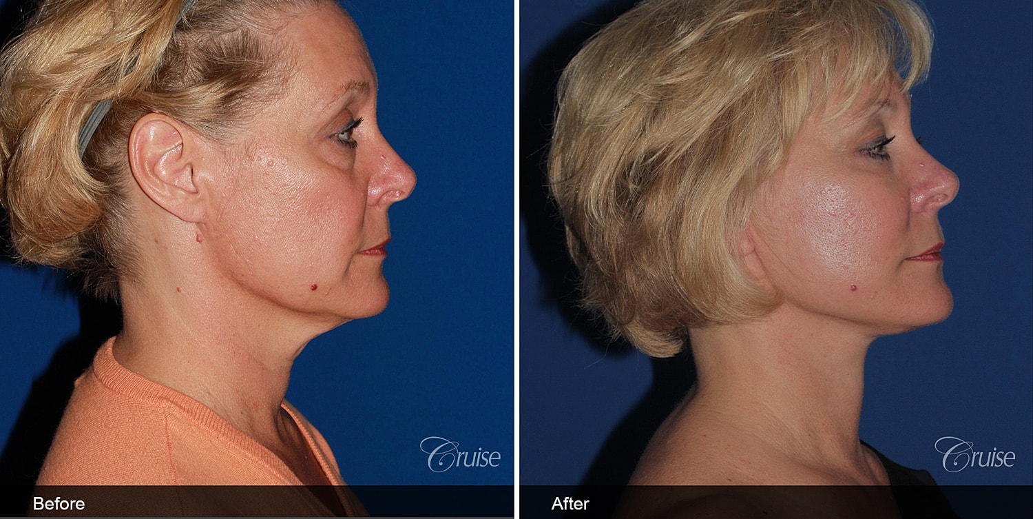 Neck Lift Before & After