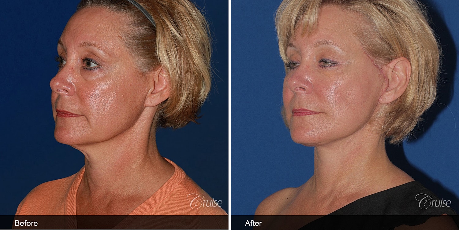 Neck Lift Before & After