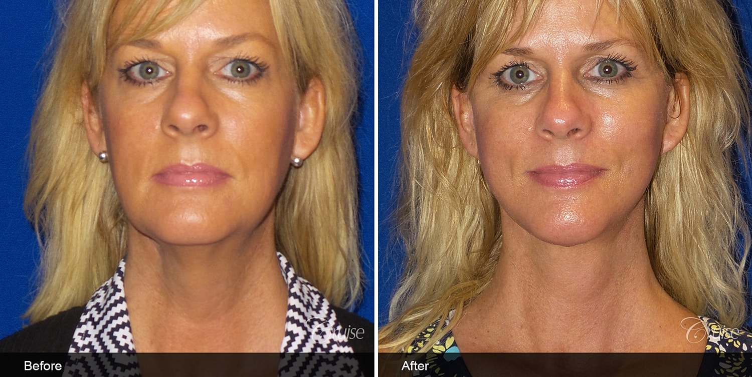 Neck Lift Before & After