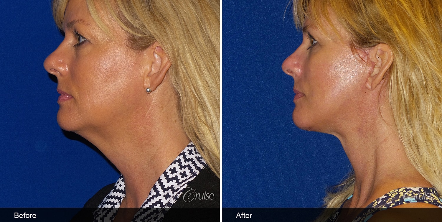 Neck Lift Before & After