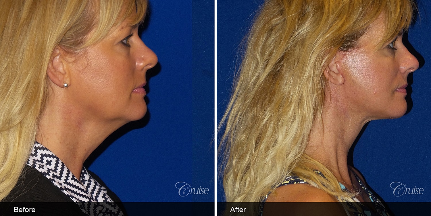 Neck Lift Before & After