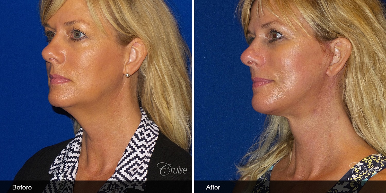 Neck Lift Before & After