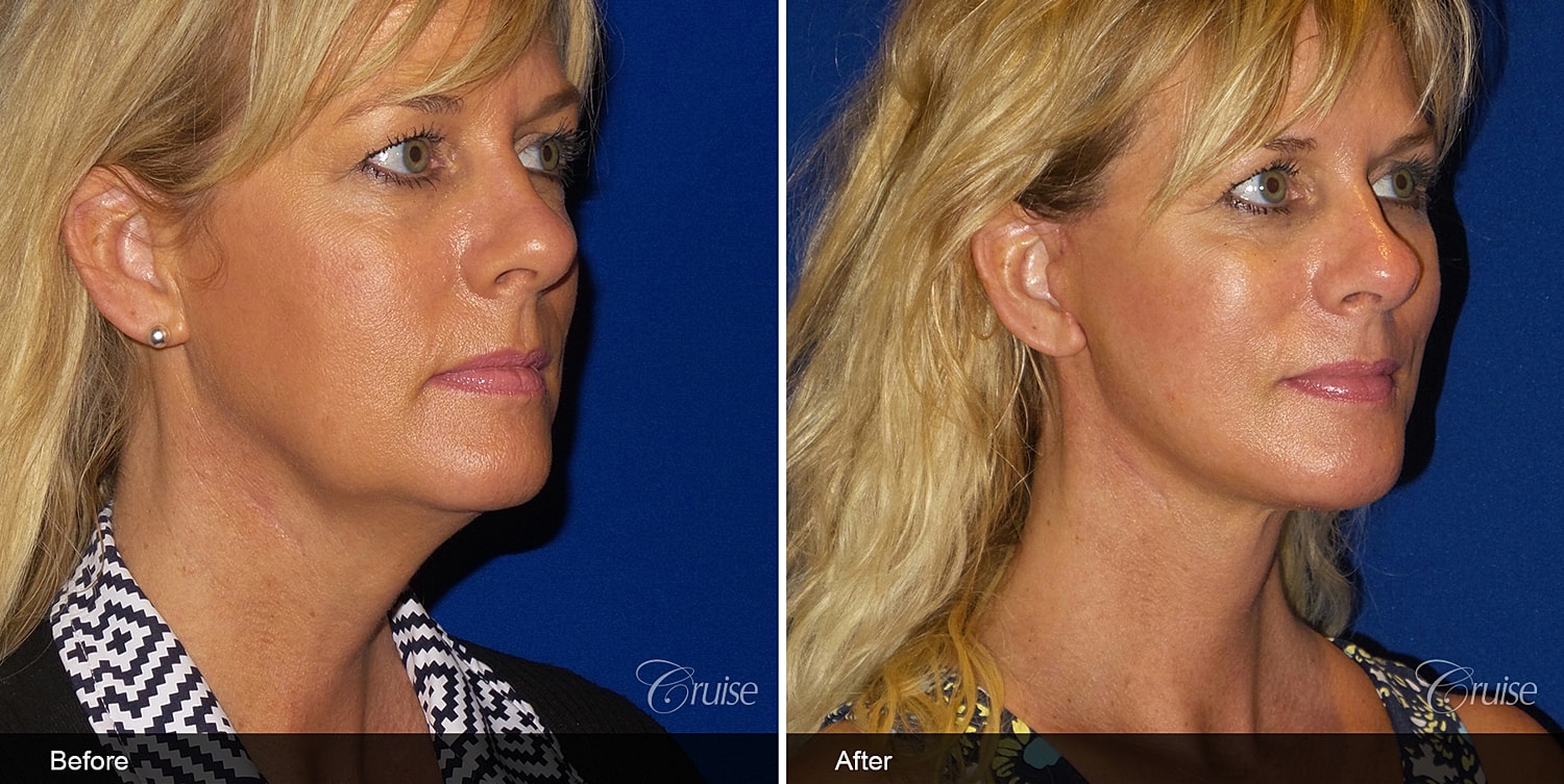 Neck Lift Before & After