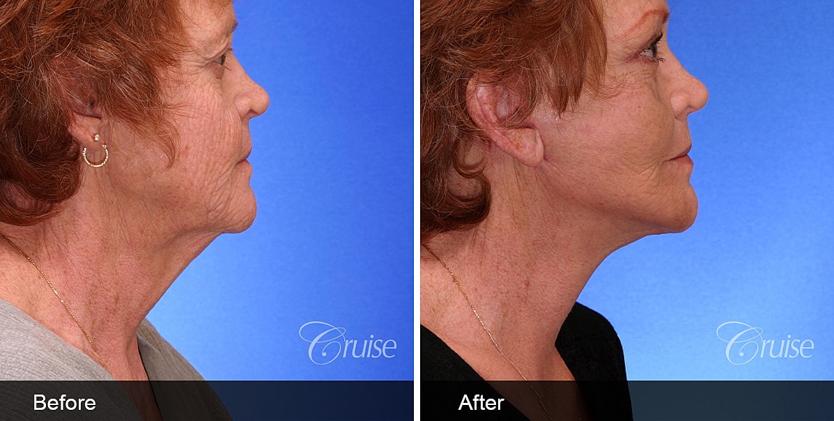 Neck Lift Before & After