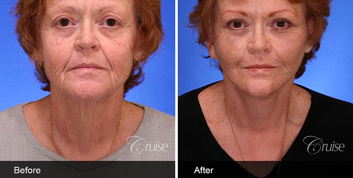 Neck Lift Before & After