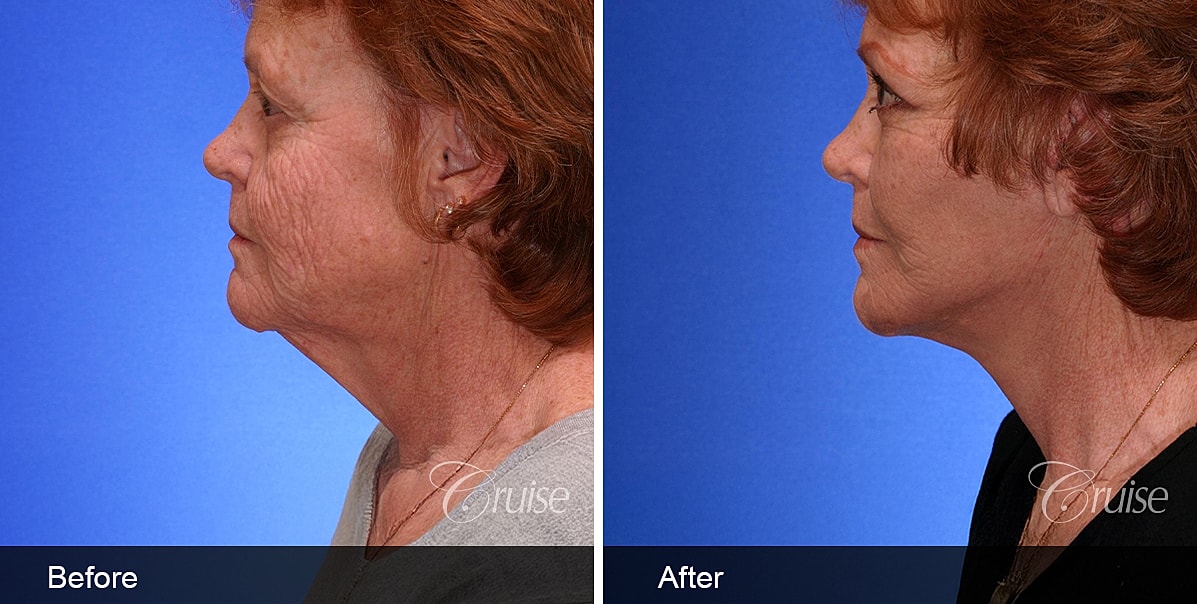 Neck Lift Before & After