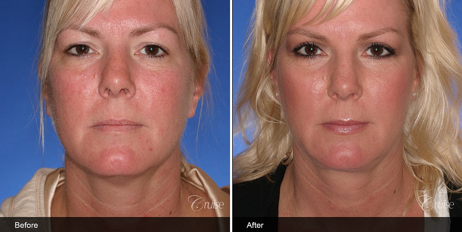 Neck Lift Before & After