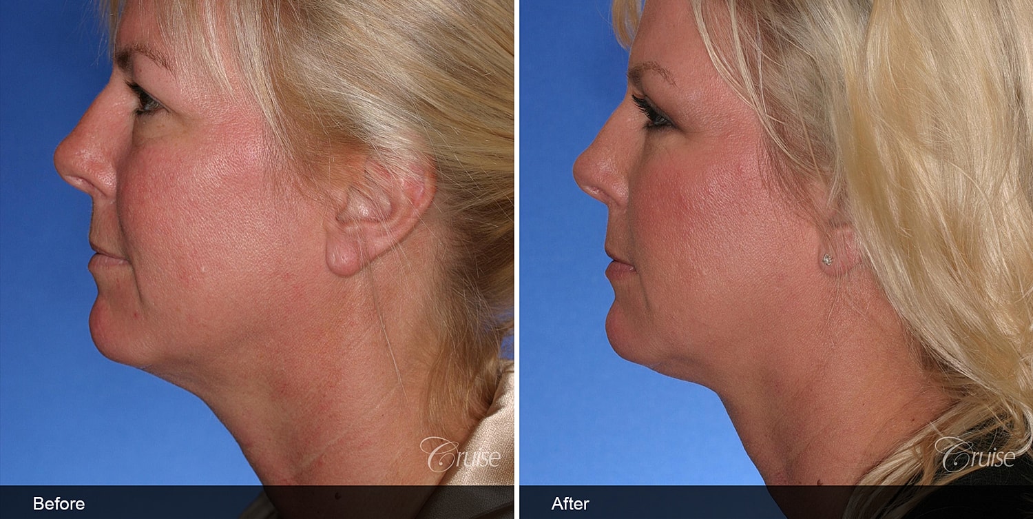 Neck Lift Before & After