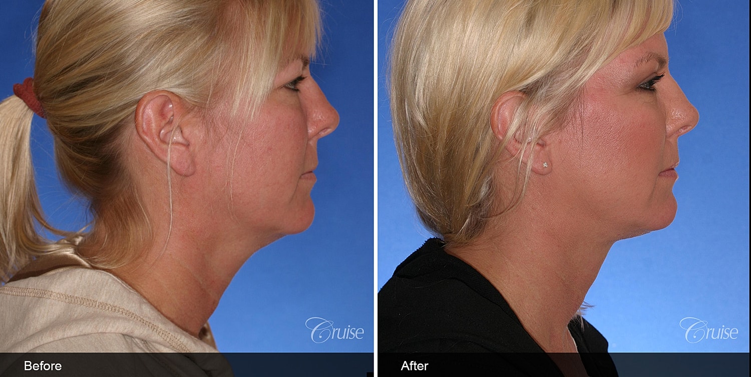 Neck Lift Before & After