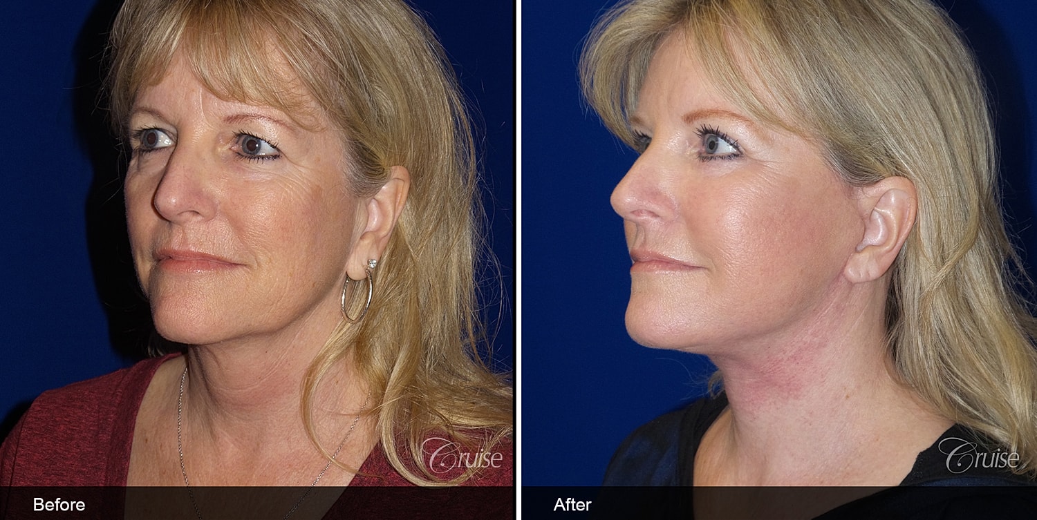 Neck Lift Before & After