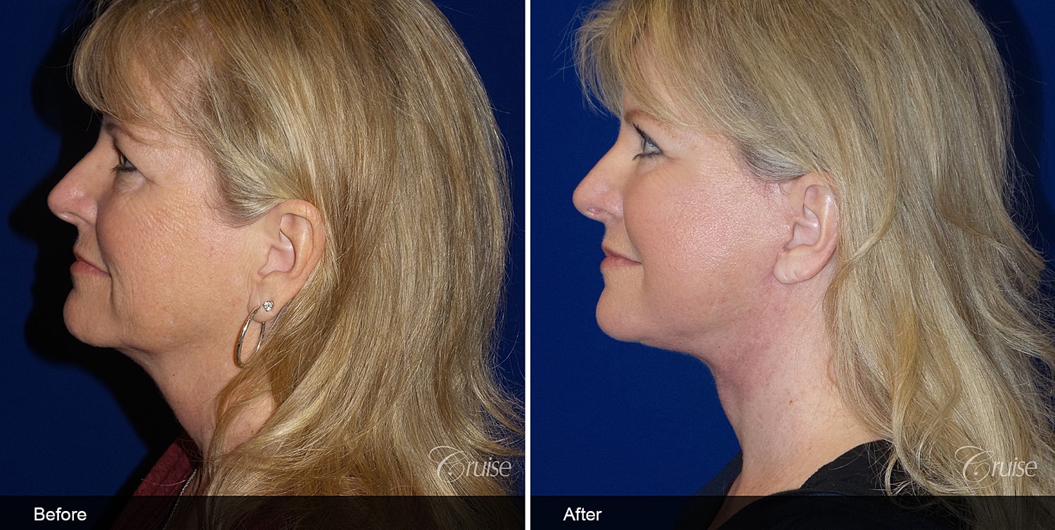 Neck Lift Before & After