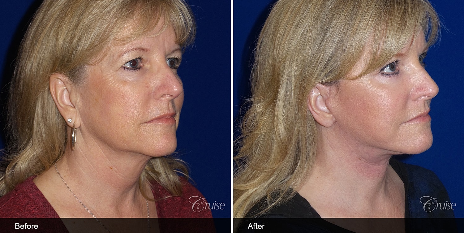 Neck Lift Before & After