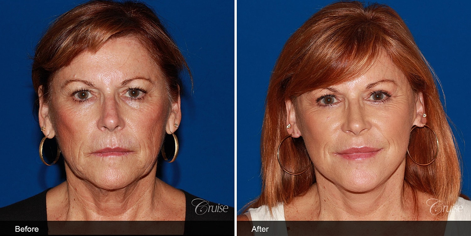 Neck Lift Before & After