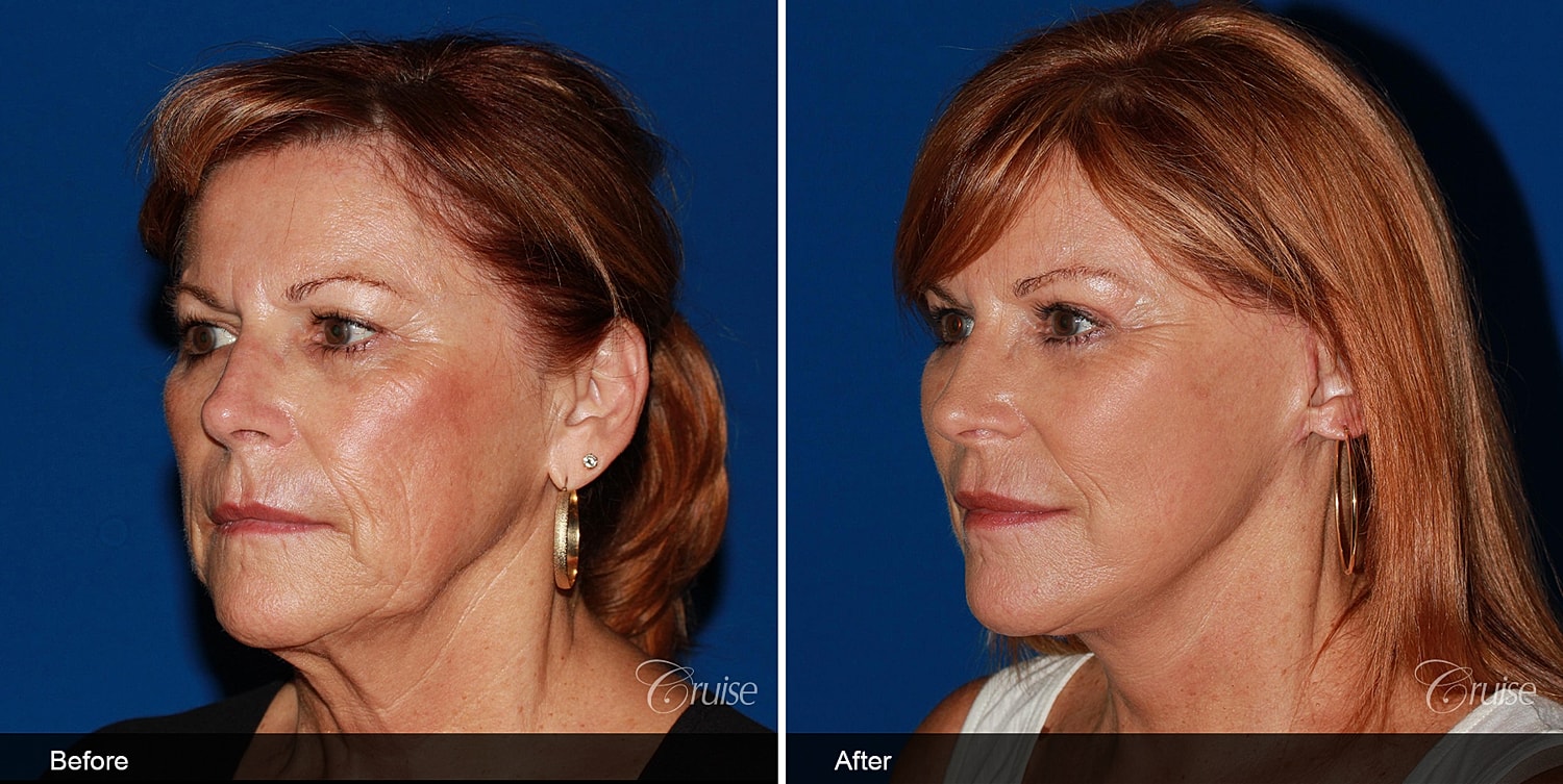 Neck Lift Before & After