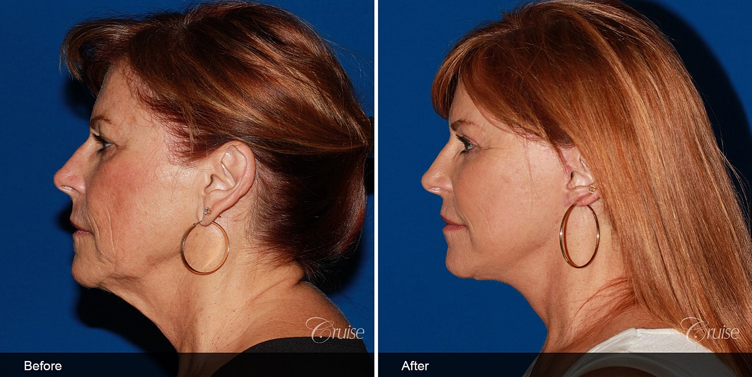 Neck Lift Before & After