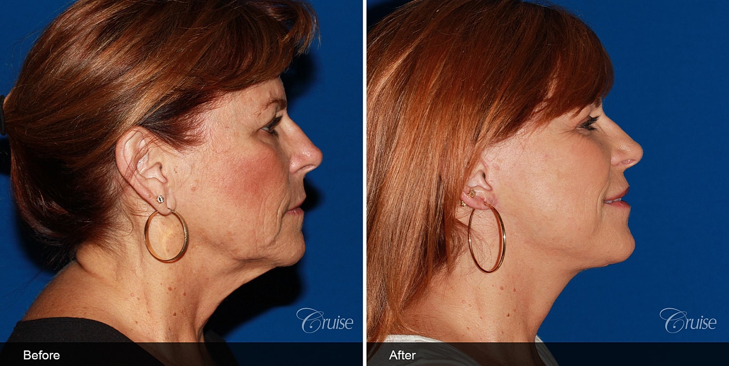 Neck Lift Before & After