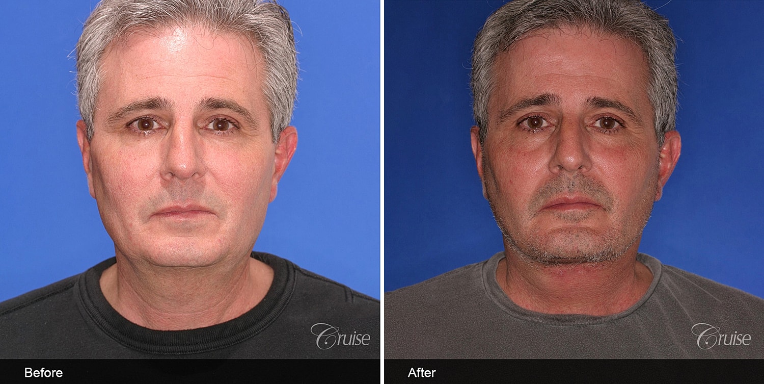 Neck Lift Before & After