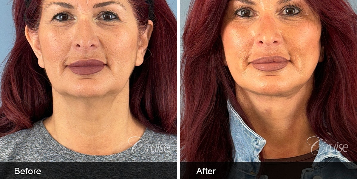 Neck Lift Before & After