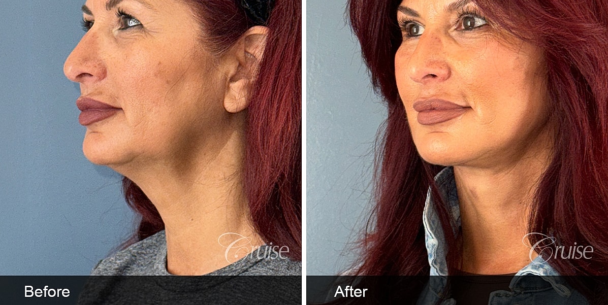 Neck Lift Before & After