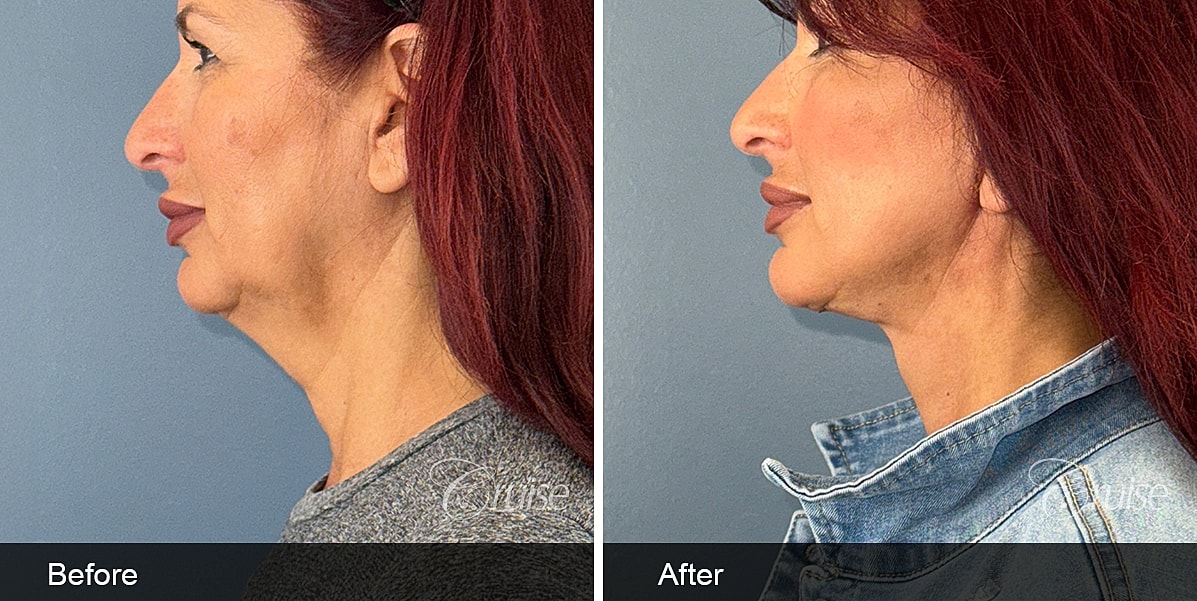 Neck Lift Before & After