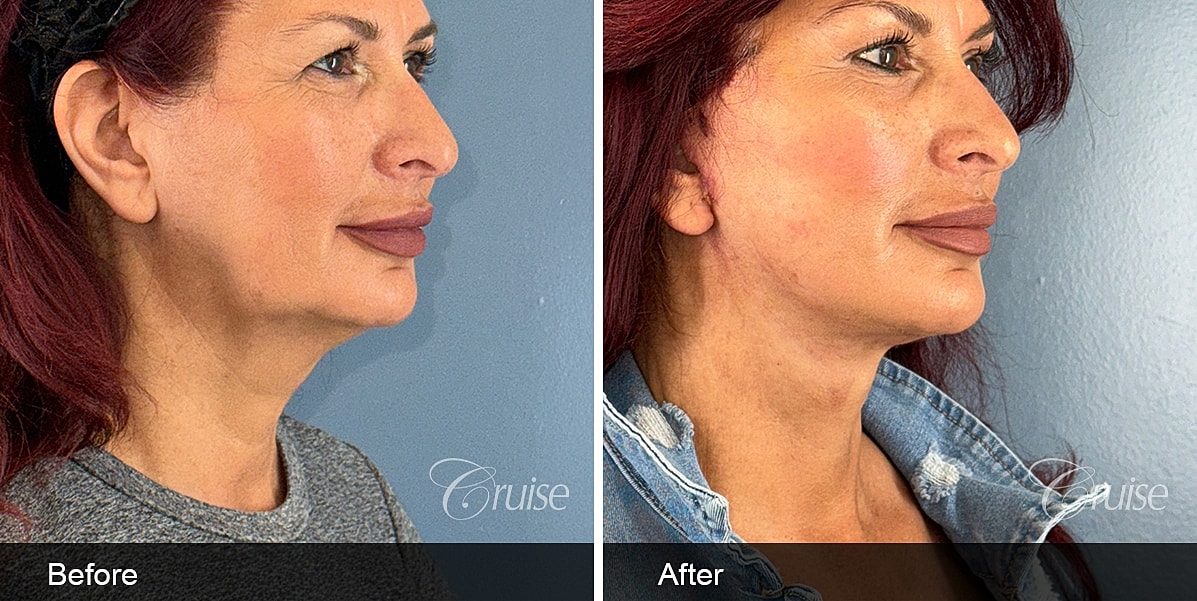 Neck Lift Before & After