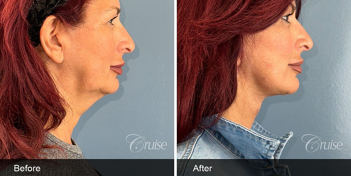 Neck Lift Before & After