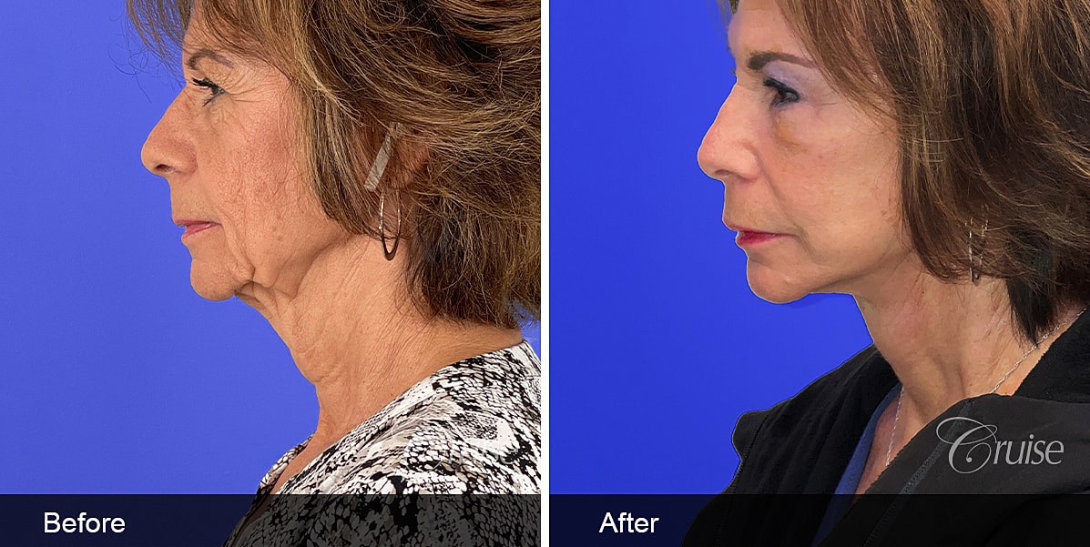 Neck Lift Before & After