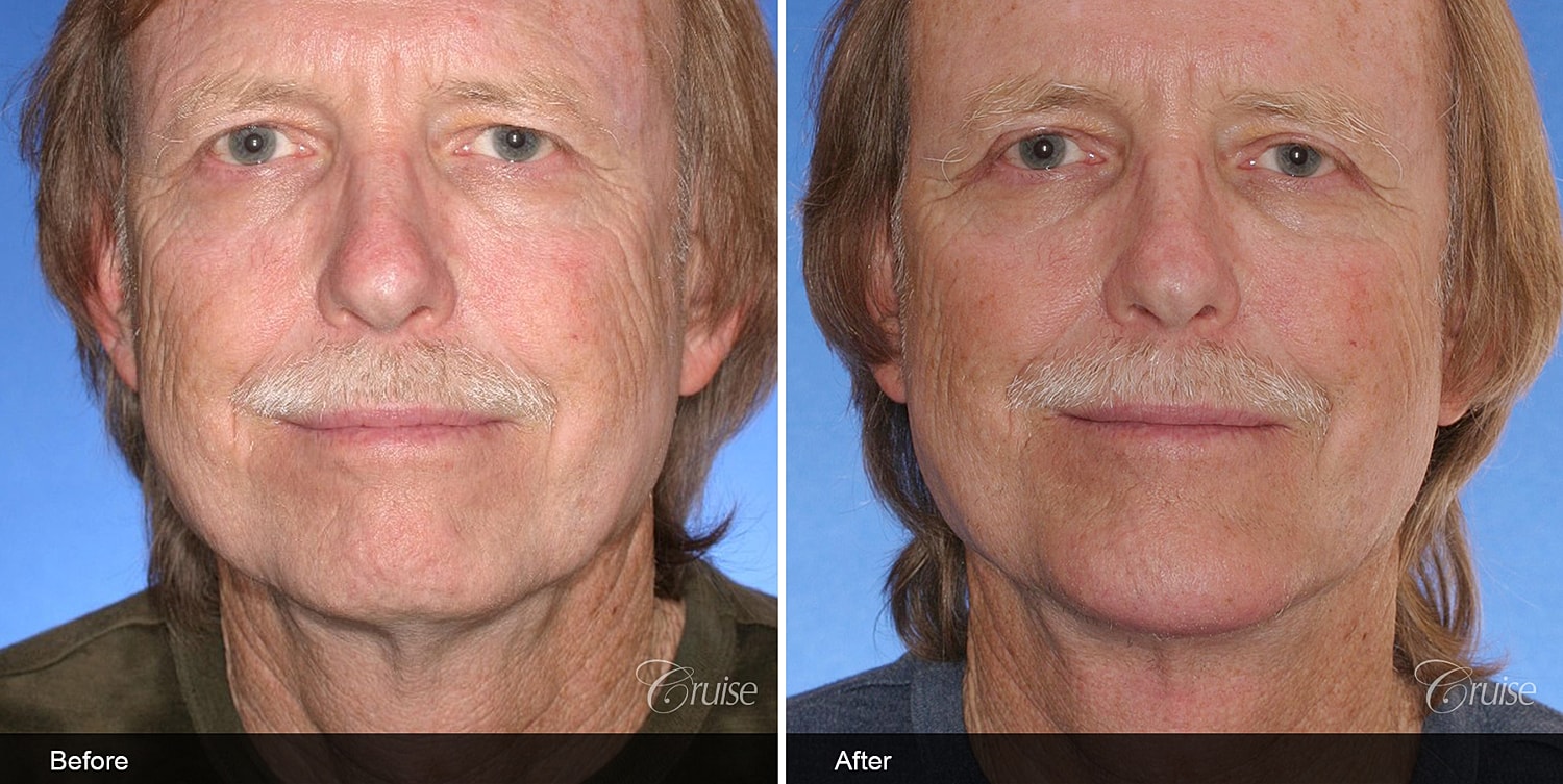 Neck Lift Before & After