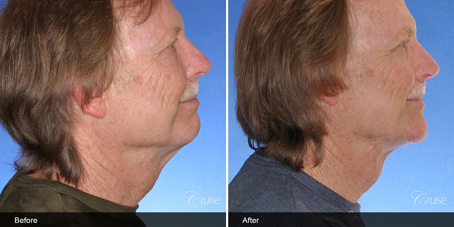 Neck Lift Before & After