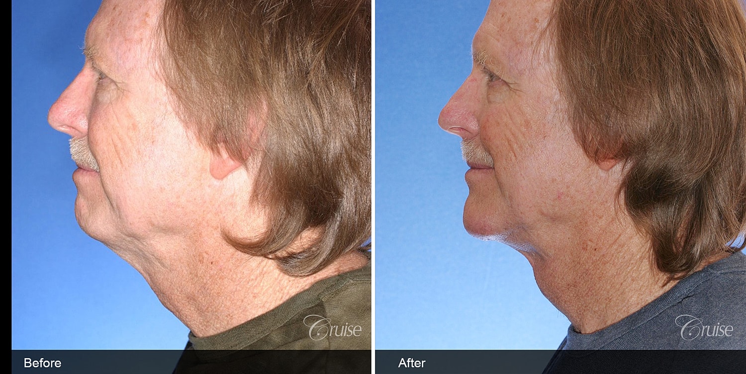 Neck Lift Before & After