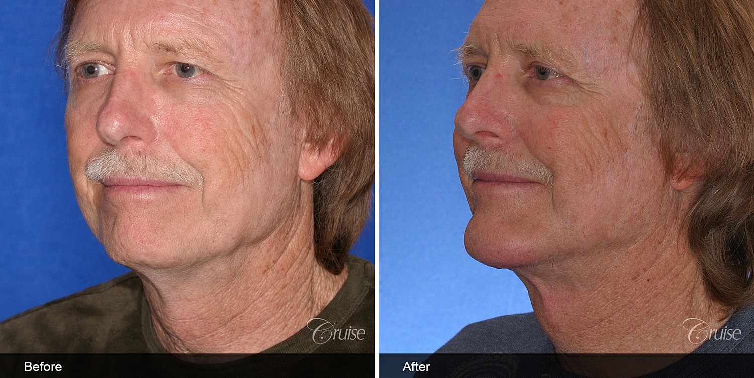 Neck Lift Before & After