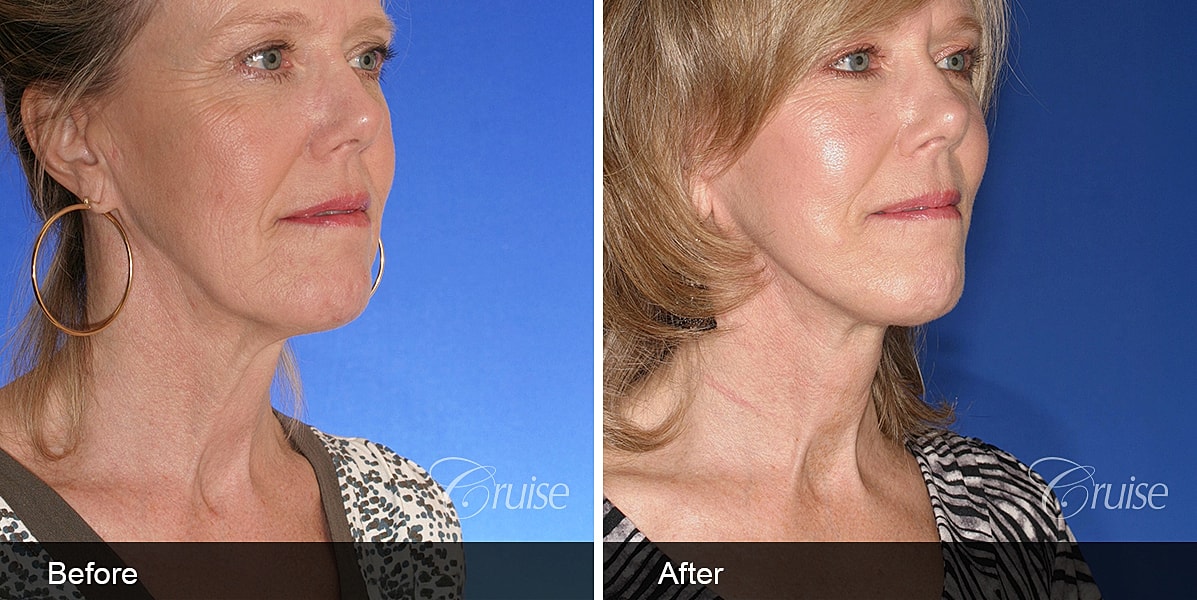 Neck Lift Before & After