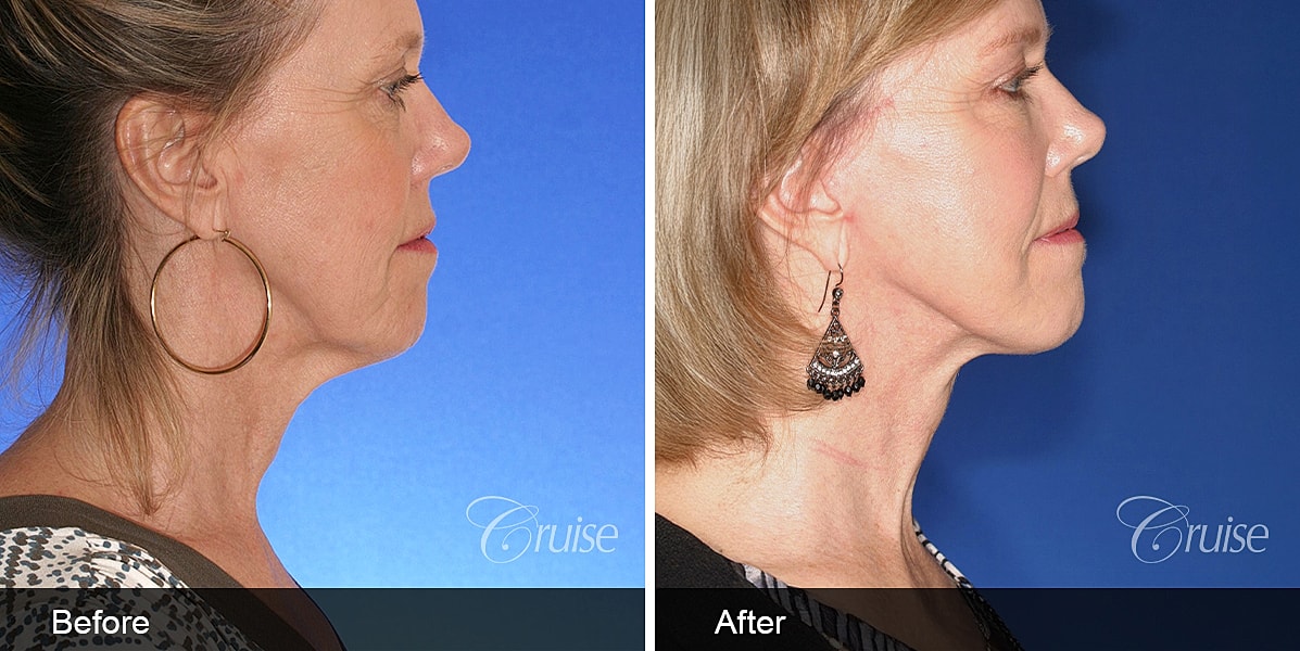 Neck Lift Before & After