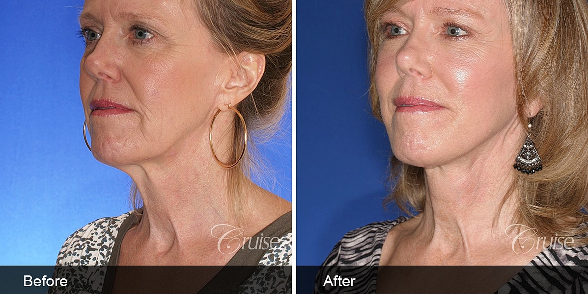 Neck Lift Before & After