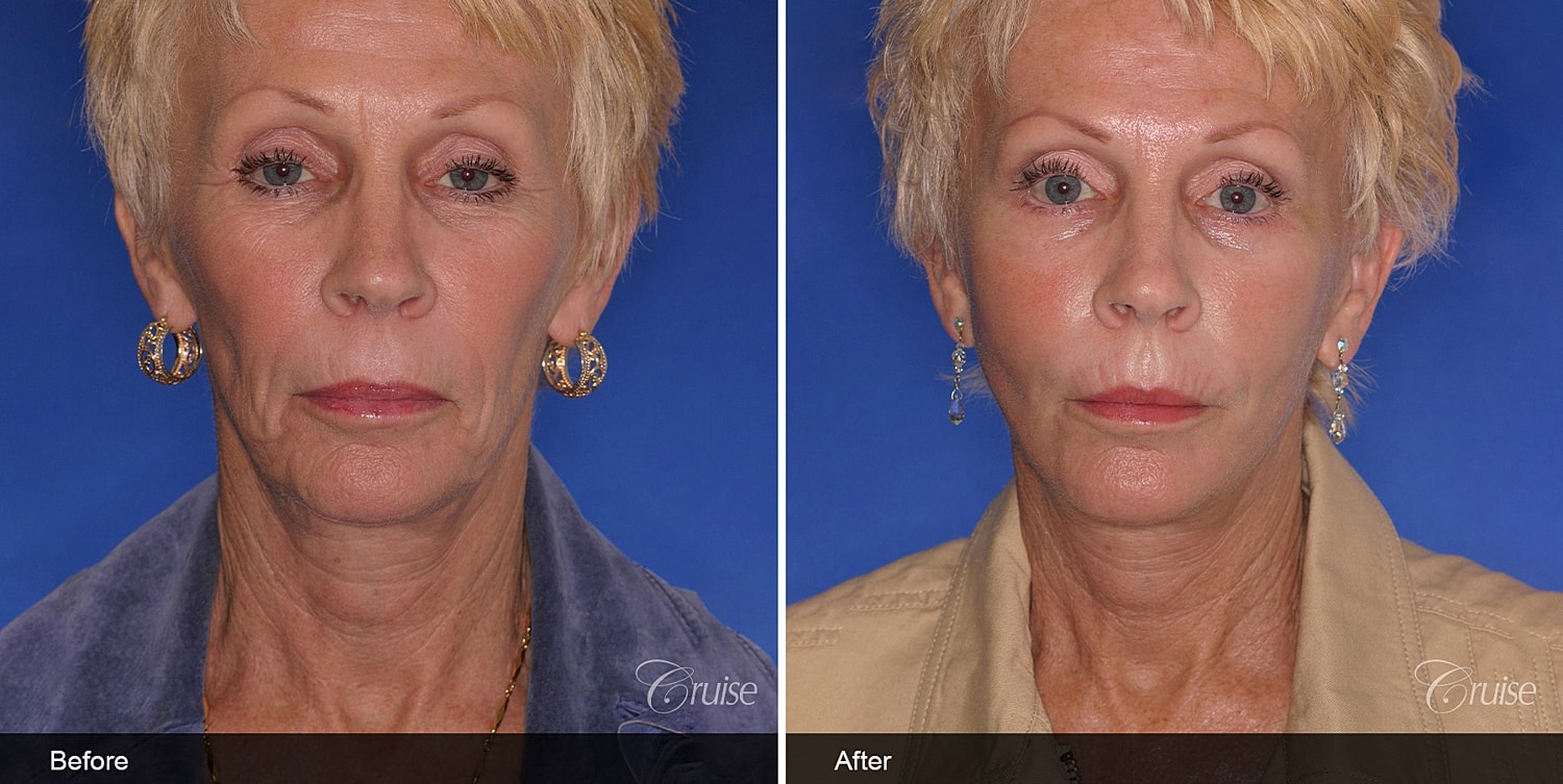 Neck Lift Before & After