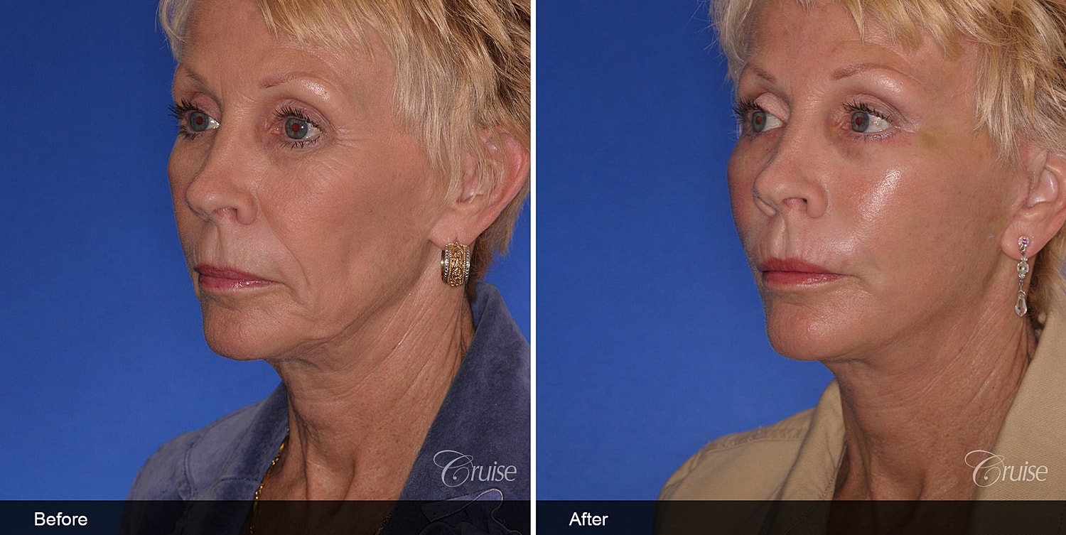 Neck Lift Before & After