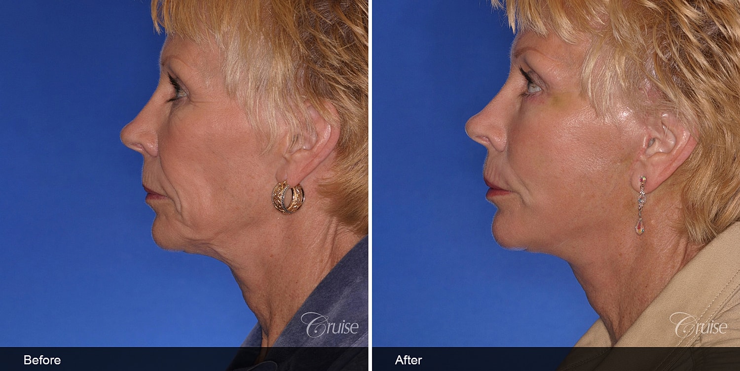 Neck Lift Before & After