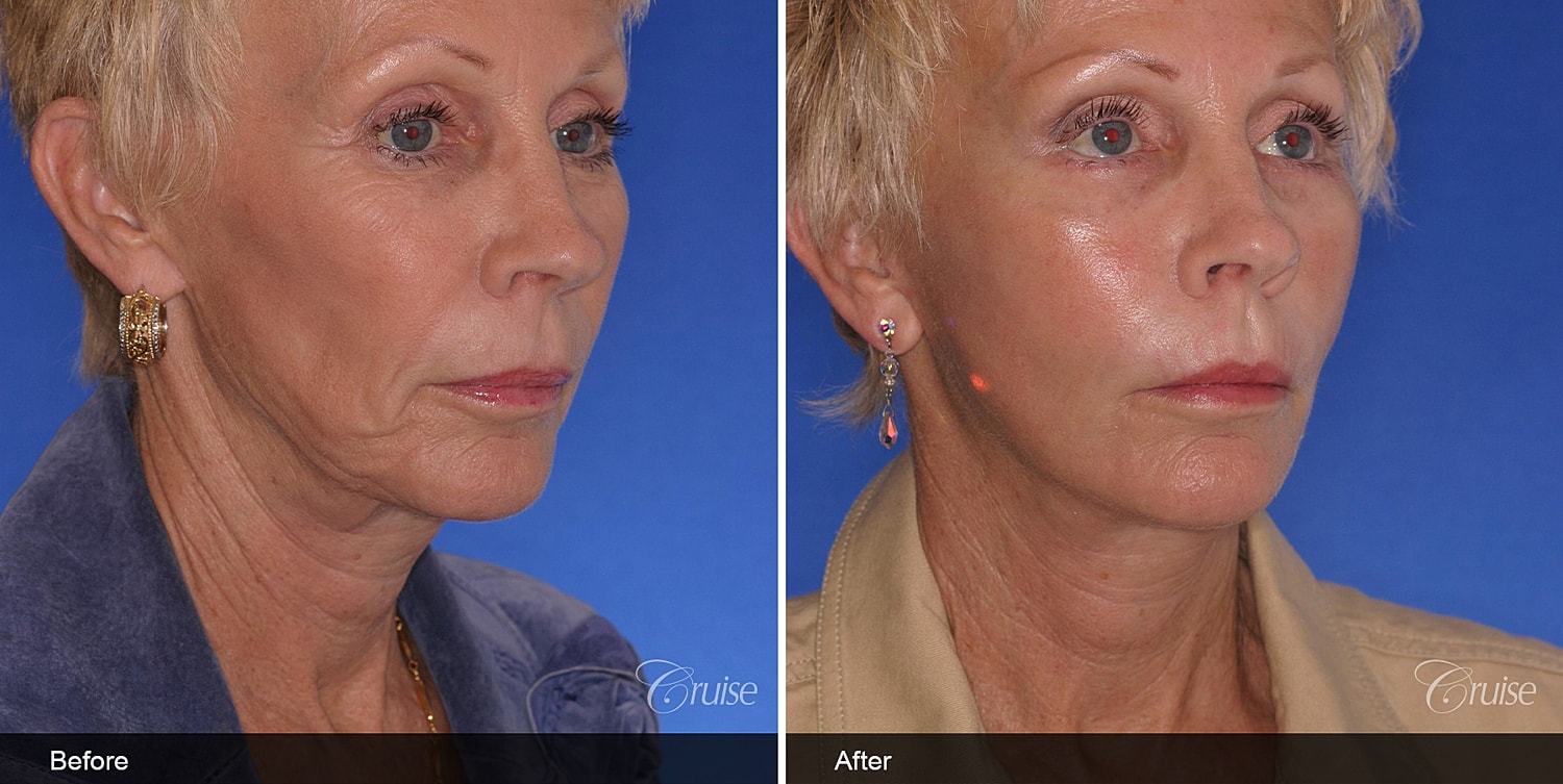 Neck Lift Before & After